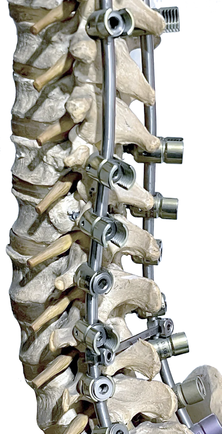 Posterior Fixation Rod Ø6–6.5 mm – catalogue image